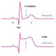 Características clínicas del infarto agudo de miocardio con elevación del segmento ST