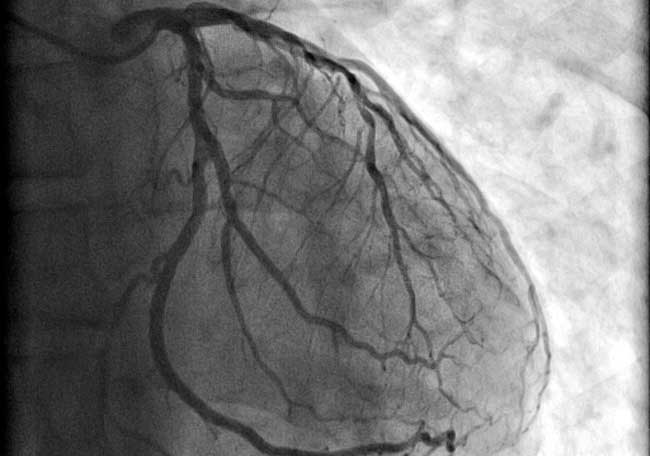 Terapia de Reperfusión en pacientes con infarto de miocardio con elevación del segmento ST