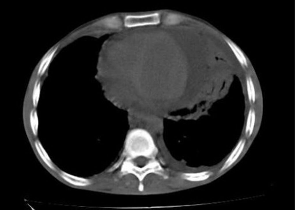 Derrame y taponamiento pericárdico
