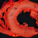 Ruptura Miocárdica en pacientes con infarto al miocardio