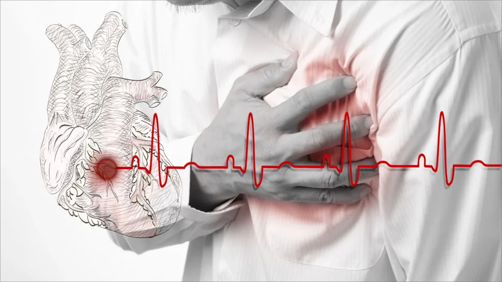 Trombosis Mural en pacientes con infarto al miocardio