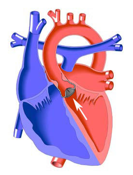 ¿Qué es la estenosis aórtica severa?