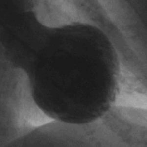 CARDIOPATÍA TAKOTSUBO