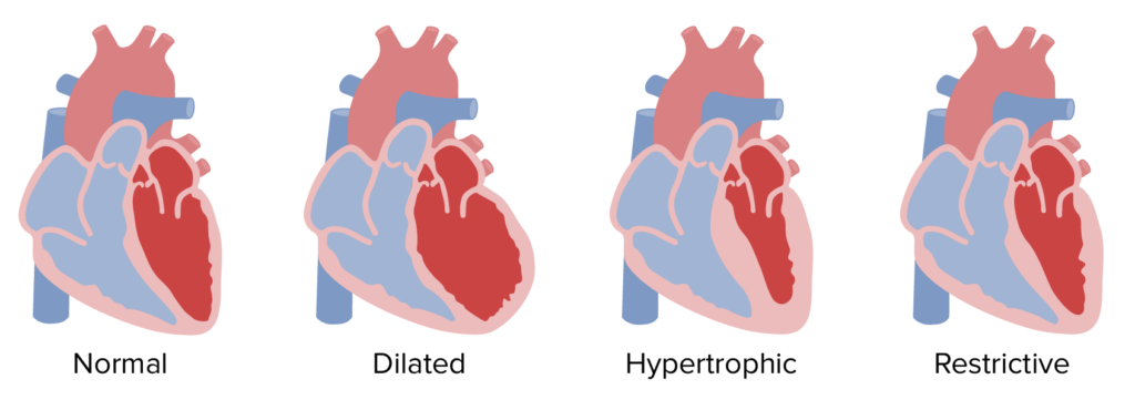 Miocardiopatía restrictiva