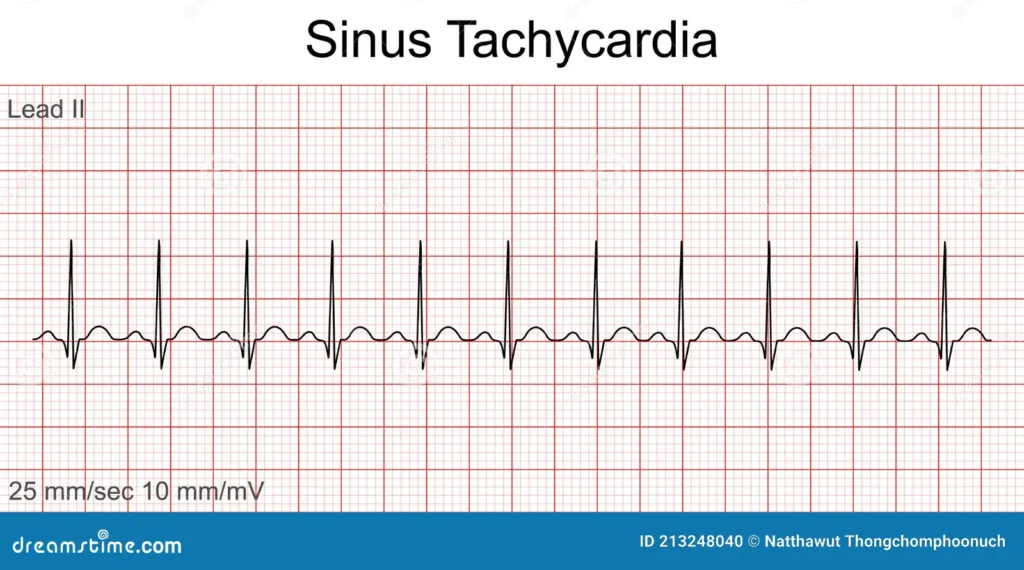 Arritmia sinusal, bradicardia y taquicardia.