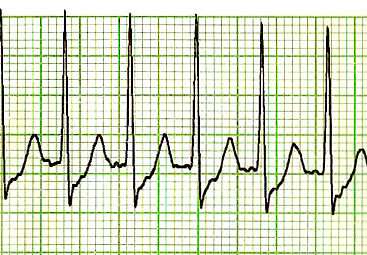taquicardia supraventricular paroxística