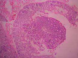 Poliposis adenomatosa familiar