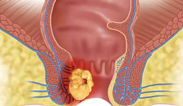 Abscesos y fístula perianal