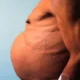 Fisiopatogénia de la ascitis refractaria