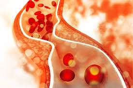 ¿Qué es la Enfermedad arterial periférica aterosclerótica?