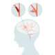 Enfermedad cerebrovascular oclusiva
