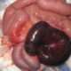 Isquemia mesentérica (Angina intestinal)