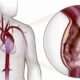 Aneurismas del aorta torácica