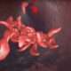 Combinación de Anemia Falciforme y Talasemia