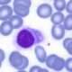 Leucemia de células pilosas