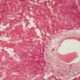 Amiloidosis