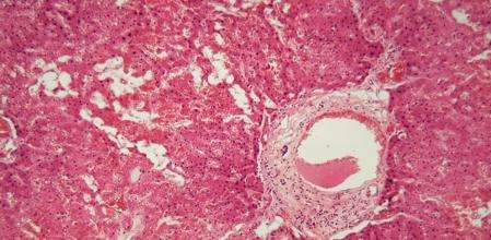 Amiloidosis