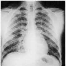 Lesión pulmonar aguda relacionada con la transfusión