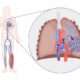 Estratificación de riesgos para la terapia anticoagulante inicial adecuada para la enfermedad tromboembólica venosa