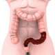 Evaluación y manejo de pacientes con hemorragia del tubo digestivo bajo