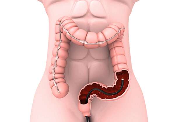 Evaluación y manejo de pacientes con hemorragia del tubo digestivo bajo
