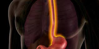 Complicaciones de la enfermedad por reflujo esofágico