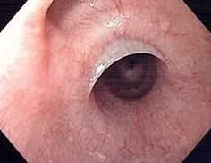 Membranas y Anillos Esofágicos