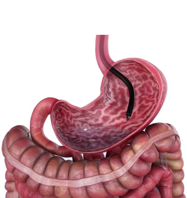 Diferenciación entre "gastropatía" y "gastritis"