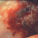 Gastropatía erosiva y hemorrágica