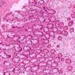 Gastritis no erosiva, inespecífica y metaplasia intestinal