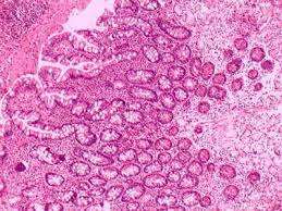 Gastritis no erosiva, inespecífica y metaplasia intestinal