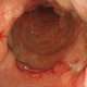 Gastritis flemonosa
