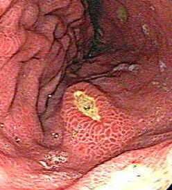 Úlceras gástricas refractarias