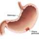 Úlcera gastroduodenal perforada