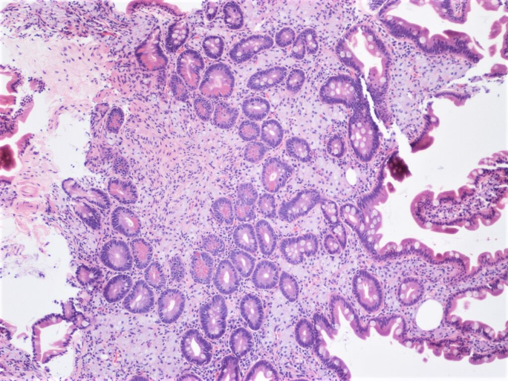 Enfermedad de Whipple