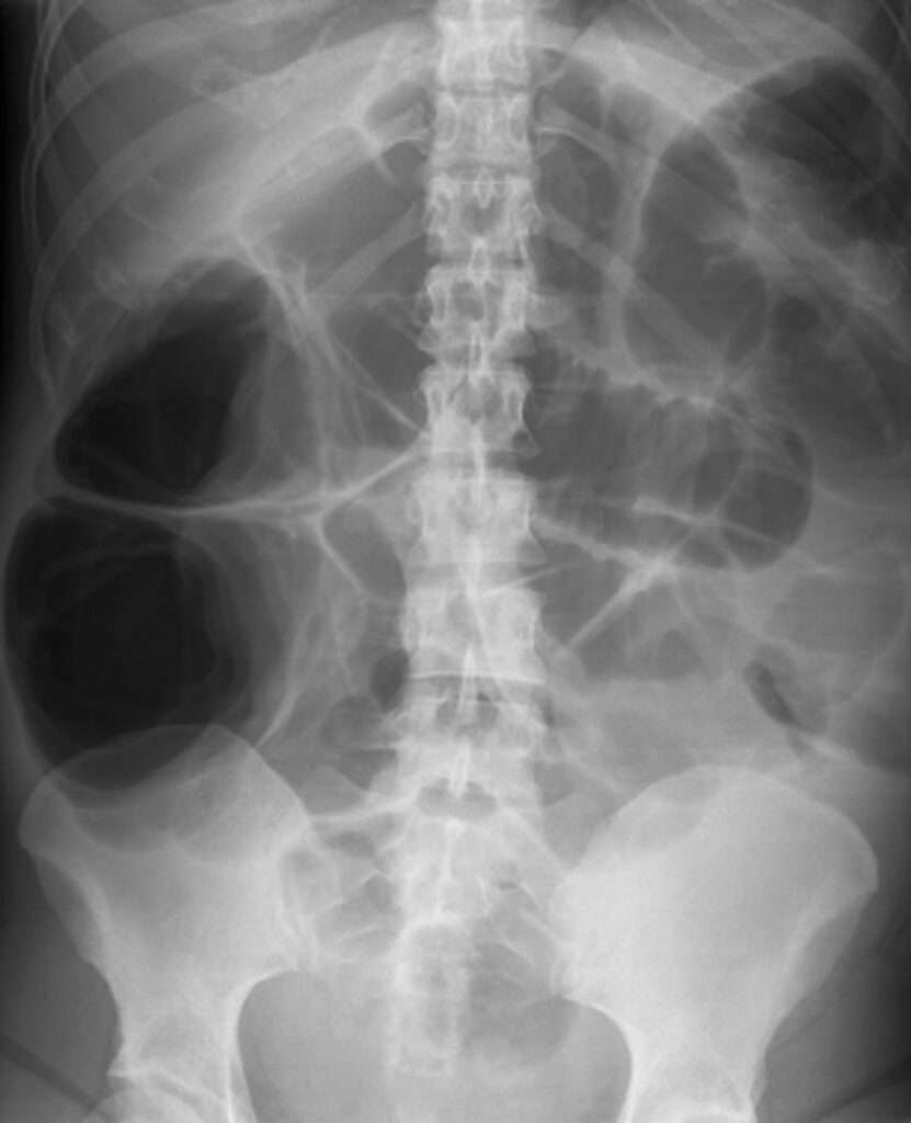 Pseudoobstrucción aguda de la colon (síndrome de Ogilvie)