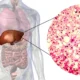 Enfermedad hepática esteatótica asociada a disfunción metabólica