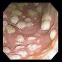 Colitis asociada a antibióticos