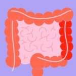 Tratamiento de la colitis ulcerosa leve a moderada