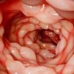 Tratamiento de la colitis ulcerosa moderada a severa
