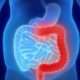 Tratamiento de la colitis severa y fulminante