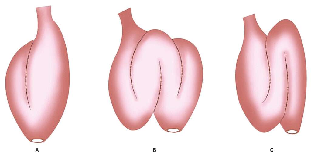 Cirugía en la Colitis Ulcerosa