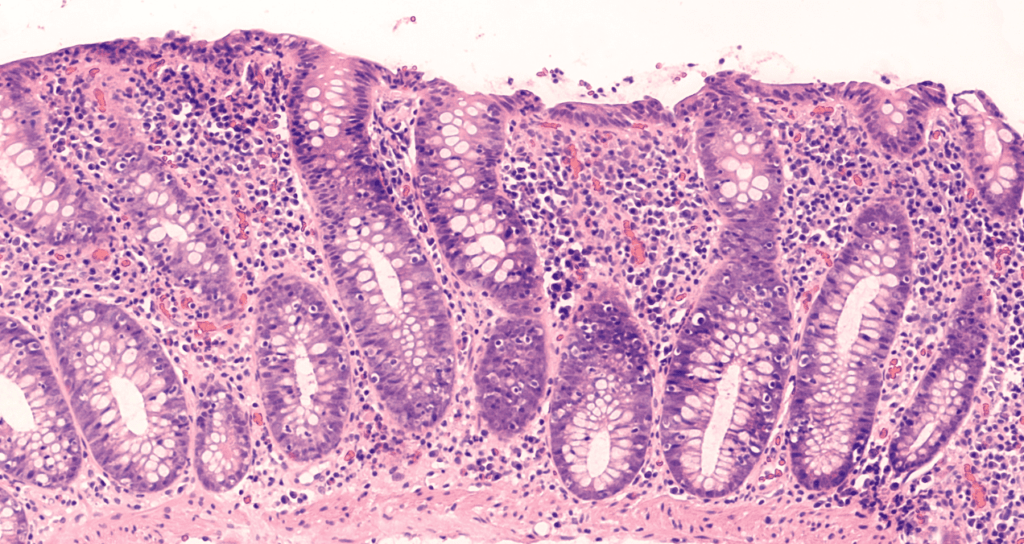 Colitis microscópica