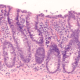 Colitis microscópica