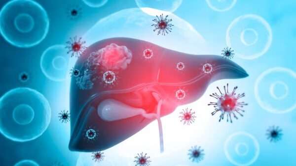 Hepatitis aguda A
