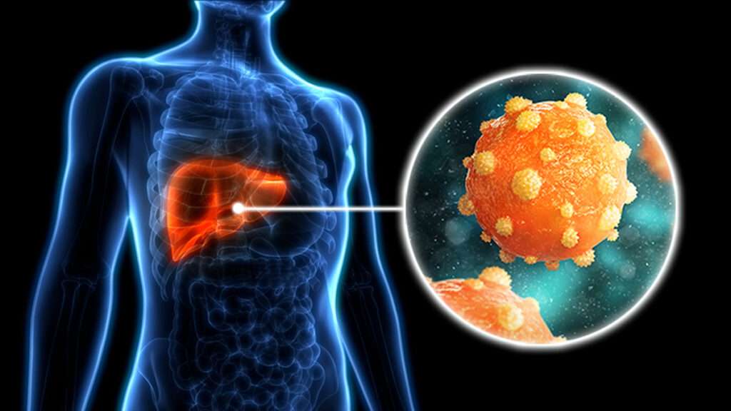 Hepatitis virales crónicas