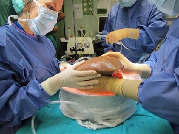 Trasplante de hígado en pacientes cirróticos