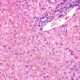Hemocromatosis