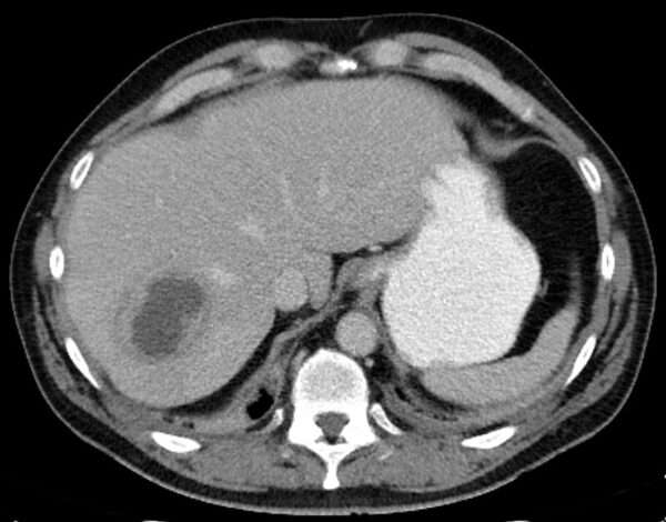 Absceso hepático piógeno