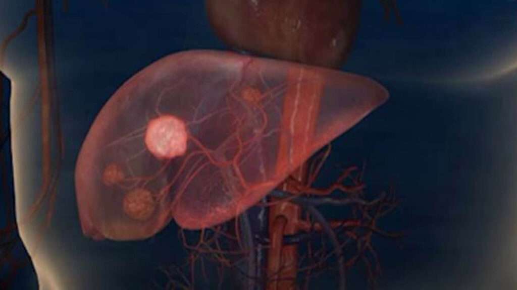 Neoplasias hepáticas benignas